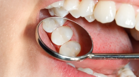 Closeup of dental mirror in mouth