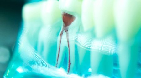 Closeup of damaged tooth and root in lower arch