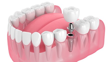 Illustration of a single dental implant