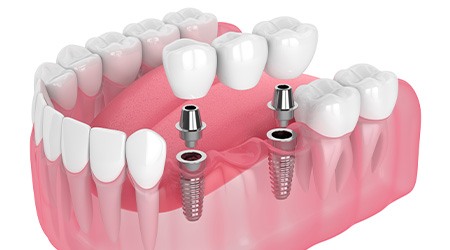 Illustration of an implant bridge