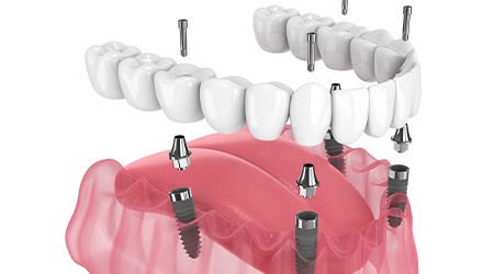 Illustration of an implant denture