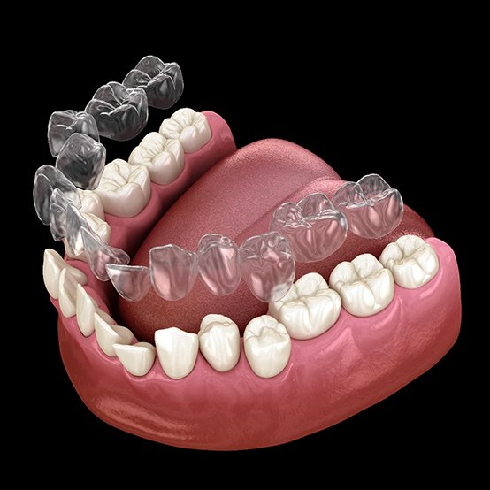 Illustrated clear aligners being placed over crooked teeth