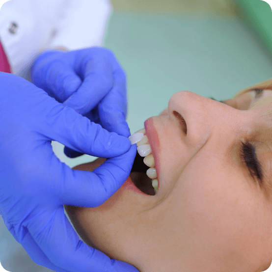 Patient's smile compared with cosmetic dental bonding shade option