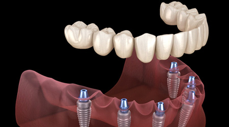 Digital illustrating showing an implant dentures in Eugene