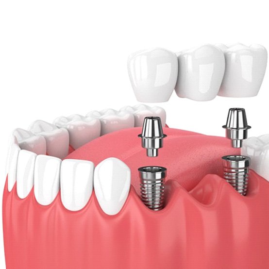 Illustration of implant bridge