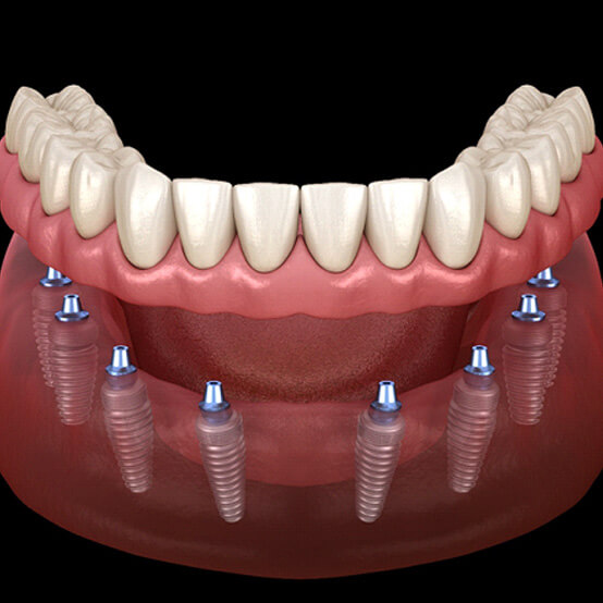 illustration of implant dentrues in euguene or for lower arch