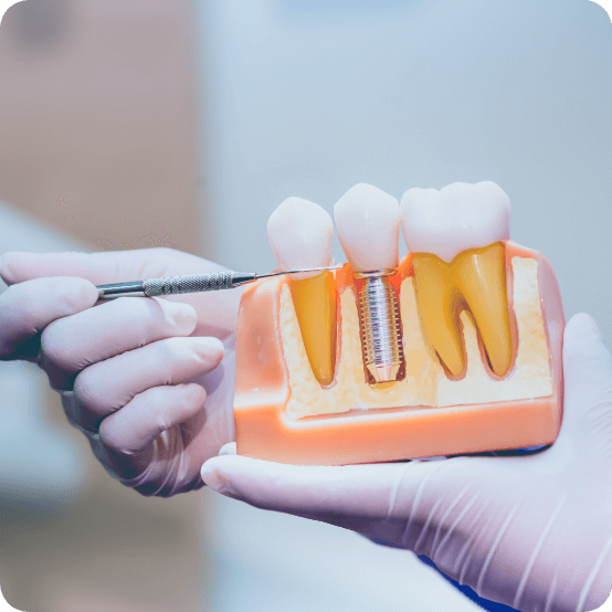 Model of smile demonstrating four step dental implant process