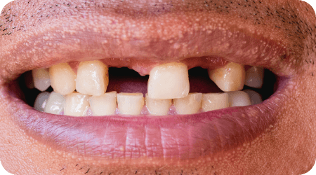 Smie with multiple missing teeth