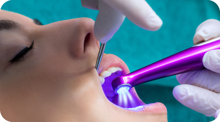 Dentist placing dental sealants