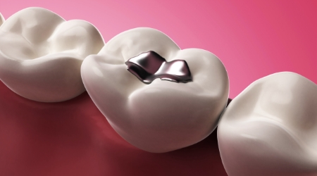 Animated smile with amalgam filling