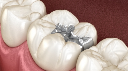 Animated smile with metal and composite fillings