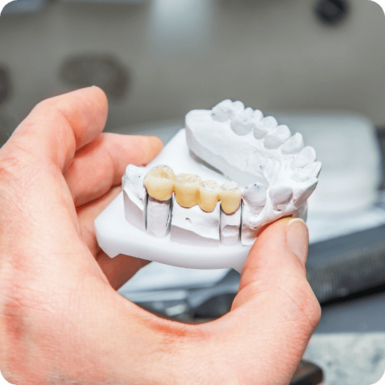 Model of a smile with dental bridge