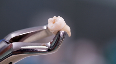 Metal clasp holding tooth after surgical tooth extractions