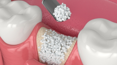 Animated smile showing bone graft surgical process