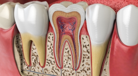 Animated inside of a tooth in need of root canal treatment
