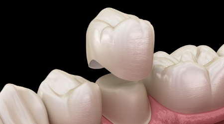 Animated dental crown being placed over a tooth