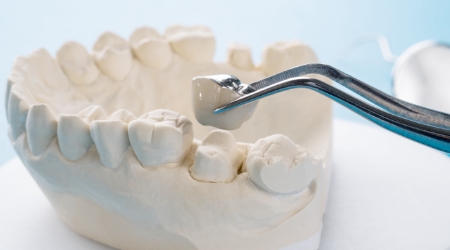 Dental crown being placed in a model of the mouth