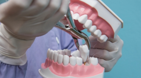 Model smile demonstrating tooth extraction procedure