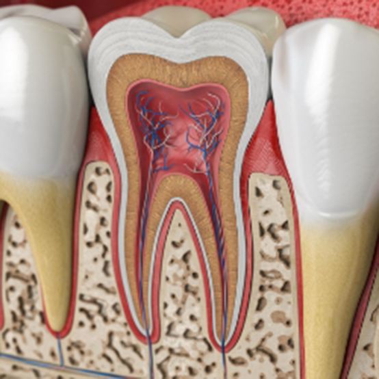 Animated inside of a tooth in need of root canal treatment