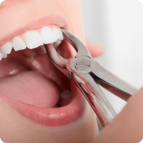 Closeup of a smile during tooth extraction