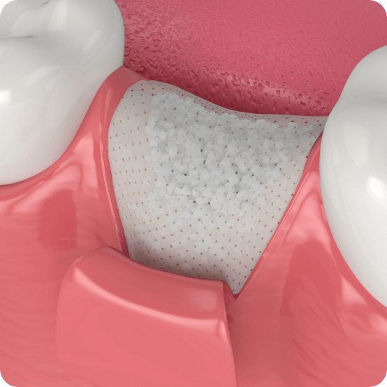 Animated smile with dental bone graft in place where missing tooth once was