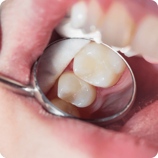 Dentist examining smile after restorative dentistry in Eugene