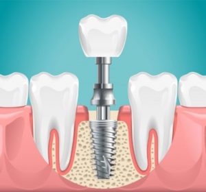 Picture of a dental implant replacing a missing back tooth.