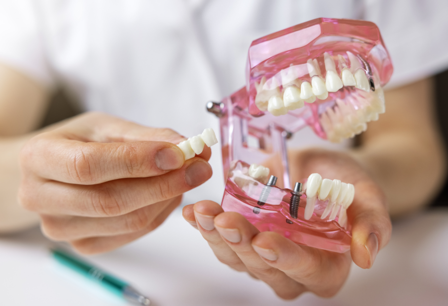 Model of dental bridge